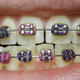 Imagen para el artículo titulado La razón por la que los aparatos para los dientes son de metal